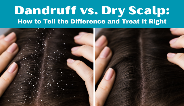 how to treat dandruff
